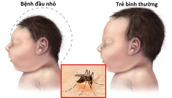 virus zika la gi cach phong tranh zika nhu the nao