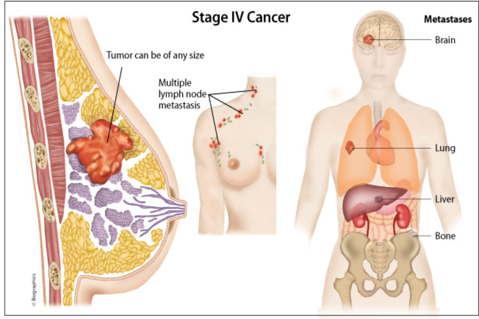 10 dấu hiệu ung thư vú giai đoạn cuối