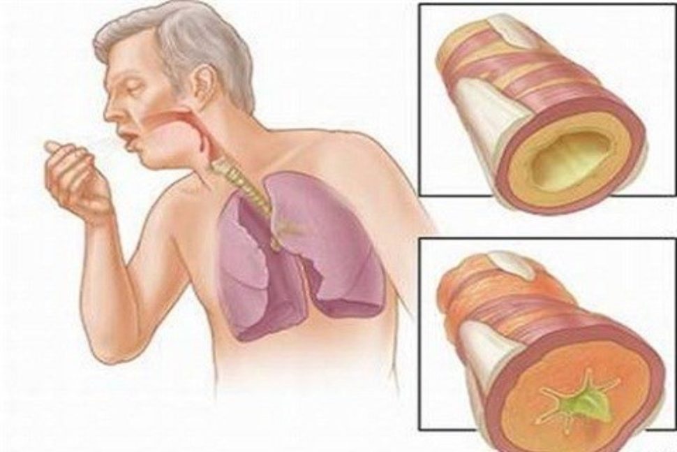 Phương pháp chữa bệnh ung thư phổi giai đoạn cuối